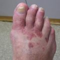 Unremitting rash on the feet