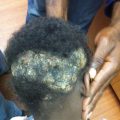 Persistent pyogenic scalp infection in a child