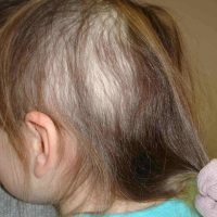 A 3-year old female with asymptomatic scalp hair loss