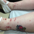 Sudden purpuric rash on the lower legs