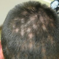 Patchy alopecia