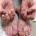 Bilateral hand and feet nail changes unresponsive to antifungal