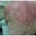 Generalized rash