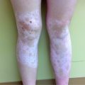 Multiple asymptomatic “white” patches