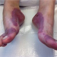 Purpuric rash in a patient with methamphetamine abuse