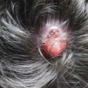 Scalp nodule in a transplant patient