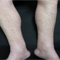 Rash on lower extremities