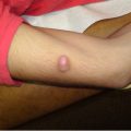 Pearly, pink protuberant tumor on the upper extremity