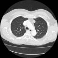 New onset of cough