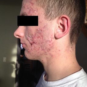 Atypical facial scarring after the initiation of isotretinoin