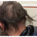 15 year old with hair loss since 3 months of age