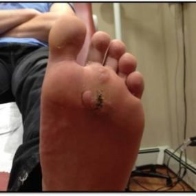 Enlarging growth on the foot of a teenage boy