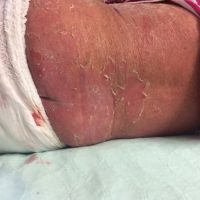 Generalized erythema and scaling