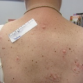 Woman with unusual nodules on her trunk and extremities