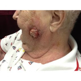 Expanding facial mass in an elderly woman