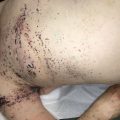 Pigmented papulonodular rash following axillary lymphadenectomy