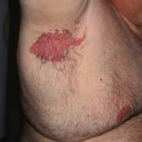 Chronic axillary rash