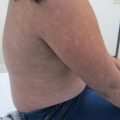 Diffuse hypopigmented rash on an eight year old girl