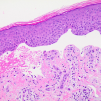 Generalized blisters after nivolumab treatment