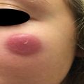 Growing lesion on the cheek of a 12-year-old female