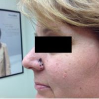 Suspicious papules on nose, chest and back