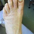 Chronic pruritic rash in a long-term care patient