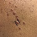 Multiple papules and nodules in female patient