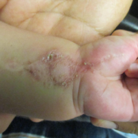 Rare Lesion On a 9-Month-Old Infant