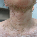 Rash Decisions: A Case of Persistent Pustules and Plaques in a Young Female