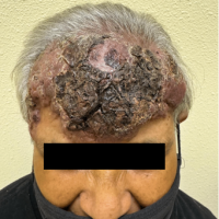 Large, Indurated, and Painful Plaque on the Forehead