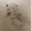 Patient with multiple grouped vesicles surrounding border of a previous surgical scar