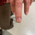 Patient with chronic painful nodule on left third fingernail