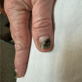 Green-black discoloration of fingernails in a 70-year-old female