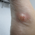 A Rapidly Growing, Tender Nodule on the Foot