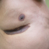 Post-Hospitalization Dilemma: Investigating Purple-Brown Plaques on the Chest