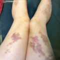 Spontaneous Bruising in a Young Female Patient