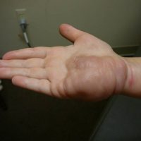 Excess skin on hand and foot